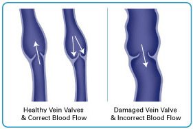 Diagram of healthy vs. damaged vein valves