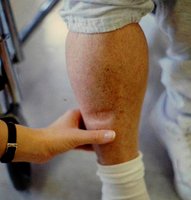 Photo of pitting edema in the leg