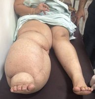 Photo of severe lymphedema
