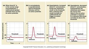 Graphs of action potentials in normokalemia, hyperkalemia, and hypokalemia