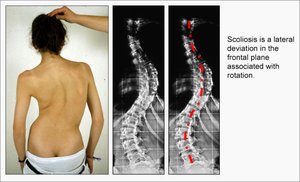 Scoliosis