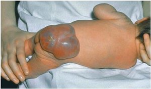 Clinical presentation of myelomeningocele