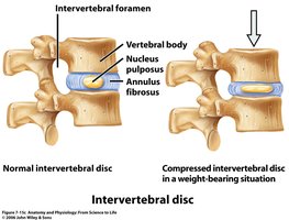 Intervertebral disc: normal and compressed