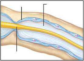 Axon regrowth and remyelination
