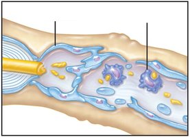 Cleanup of debris by Schwann cells and macrophages