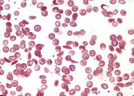 Blood smear showing various blood cell morphologies