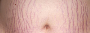 Stretch marks (striae)