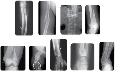 X-ray images of various fracture types