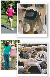 Images illustrating healthy and osteoporotic bone