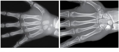 X-ray images of juvenile and adult hands showing epiphyseal cartilage and lines