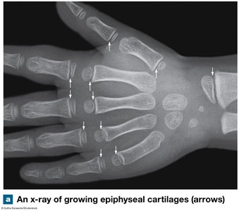X-ray of growing epiphyseal cartilages in a child's hand