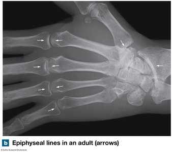 X-ray of epiphyseal lines in an adult hand