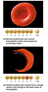 Sickle-cell anemia: normal vs sickled erythrocyte