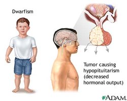 Diagram of pituitary dwarfism and hypopituitarism