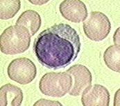 Blood smear showing lymphocyte