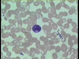 Blood smear showing monocyte