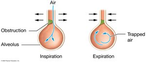Obstructive lung disease: air trapping in alveoli