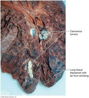 Cancerous tumor of the lung