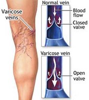 Varicose veins and valve failure
