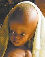 Baby with hydrocephalus