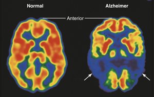 Brain activity is decreased by Alzheimer’s disease