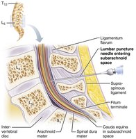 Diagram of a lumbar puncture