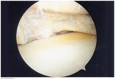 Arthroscopic view of a cartilage tear