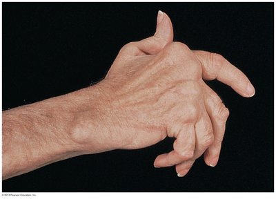 Hand with rheumatoid arthritis