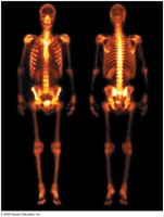 Radiotracer scan of the human body