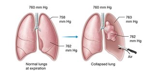 Diagram of a pneumothorax (collapsed lung)