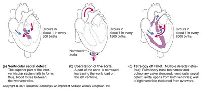 Common congenital heart defects