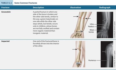 Common types of bone fractures
