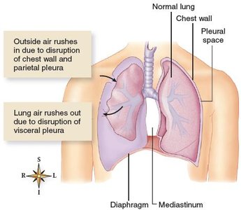 Lobar pneumonia affecting the lung