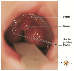 Clinical image of swollen palatine tonsils (tonsillitis)