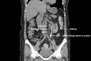 CT scan showing kidney stones and infection