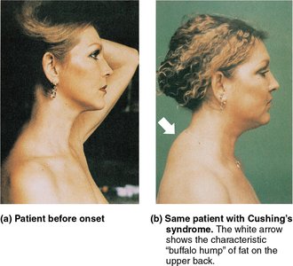 Cushing's syndrome patient with buffalo hump