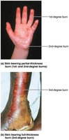Examples of first-, second-, and third-degree burns