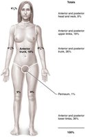 Rule of Nines for estimating burn extent