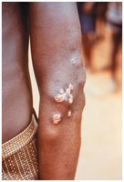 Skin lesions from nonvenereal treponemal disease