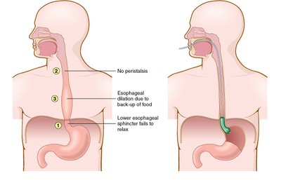 Achalasia diagram