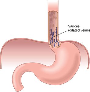 Esophageal varices