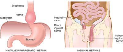 Hernia types