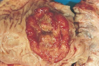 Colorectal cancer