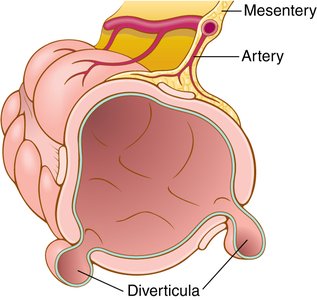 Diverticulosis