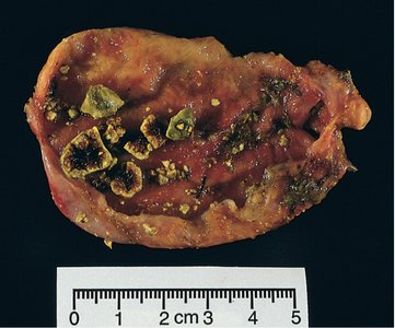 Gallstones in gallbladder