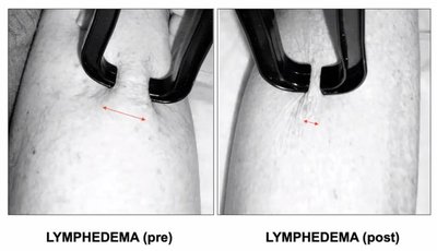 Lymphedema pre and post comparison