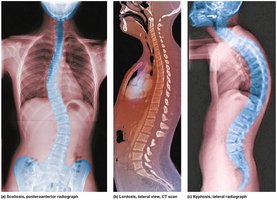 Abnormal spinal curvatures: scoliosis, lordosis, kyphosis