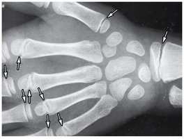 X-ray of epiphyseal cartilage