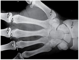 X-ray of epiphyseal lines