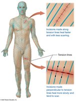 Tension lines for surgical incisions